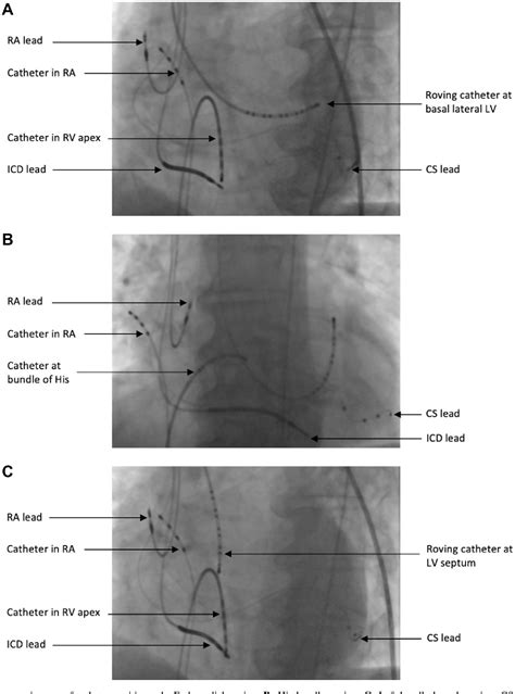 Figure 1 From Electrocardiographic Imaging Of His Bundle Left Bundle