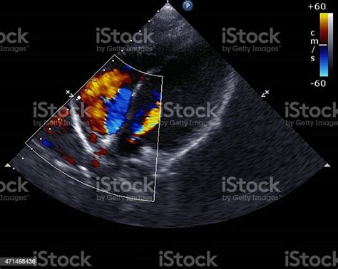 Doppler Echocardiogram Stock Photo Download Image Now Aorta