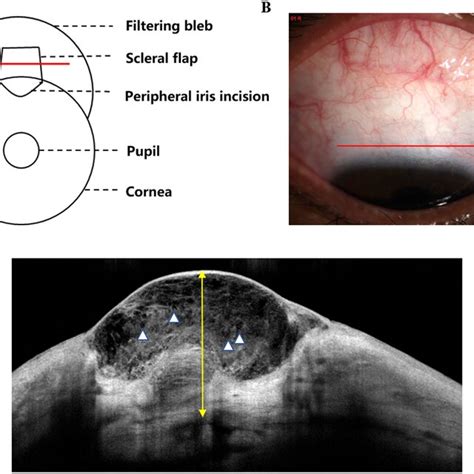 Bleb Morphology Evaluation Method A B The Scanning Position Of