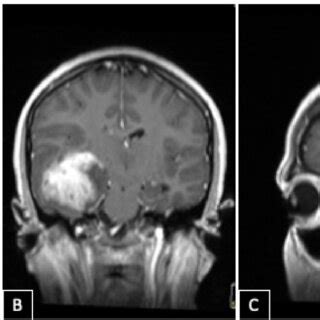 Pre-operative MRI Brain with gadolinium contrast in T1WI (A) axial, (B)... | Download Scientific ...