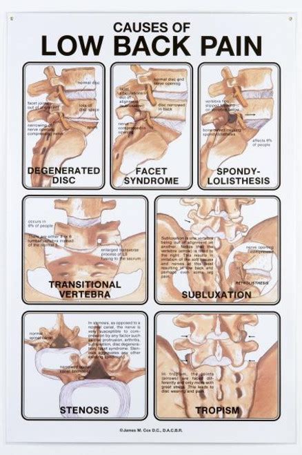 Back Pain Diagram Chart