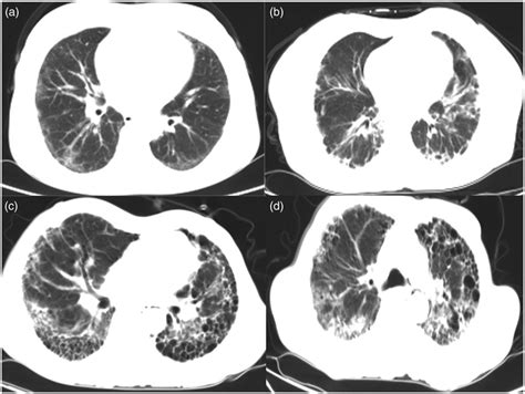 Typical HRCT scan of IPF patients. (a) Axial HRCT image acquired at the ...