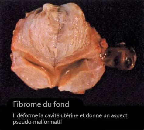 Fibrome Dr Kara Zaitri M A