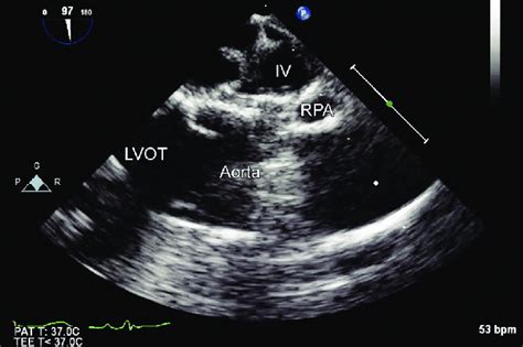 Retroaortic Innominate Vein