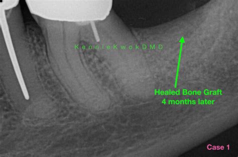 What to Expect From Bone Grafting for Dental Implants