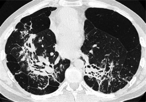 Sarcoidosis In X Ray Stage IV DocCheck