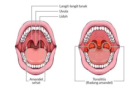 Komplikasi Radang Amandel Alodokter