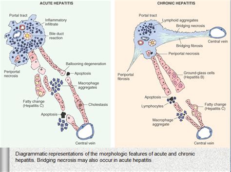 MBBS Medicine Humanity First Comparison Of Acute Hepatitis And