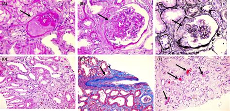 Renal Biopsy Demonstrating Sclerotic Glomeruli A Focally Segmentally Download Scientific