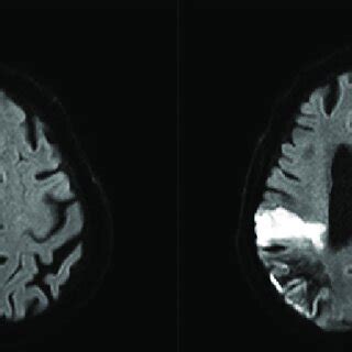 Magnetic Resonance Imaging Findings Diffusion Weighted Imaging On