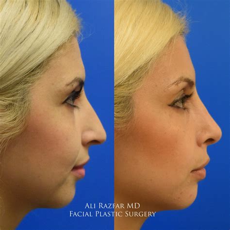 Persian Rhinoplasty Orange County Middle Eastern Nose Job Newport Beach