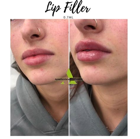 Lip Fillers Essex Dermal Fillers Essex Aesthetics Of Essex