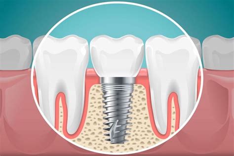 Dental Implants Important Facts You Should Know About