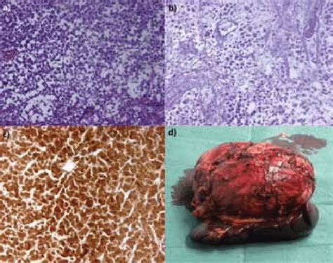 Pathologic findings of the adrenocortical carcinoma: a) EE-20x; b ...