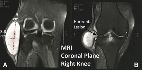 How To Perform A Giant Parameniscal Cyst Exeresis Step By Step