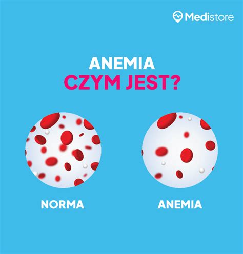 Anemia w ciąży objawy diagnostyka i leczenie niedokrwistości