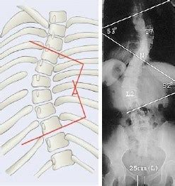 Disc Herniation Ashburn Va Spinal Stenosis Reston Va