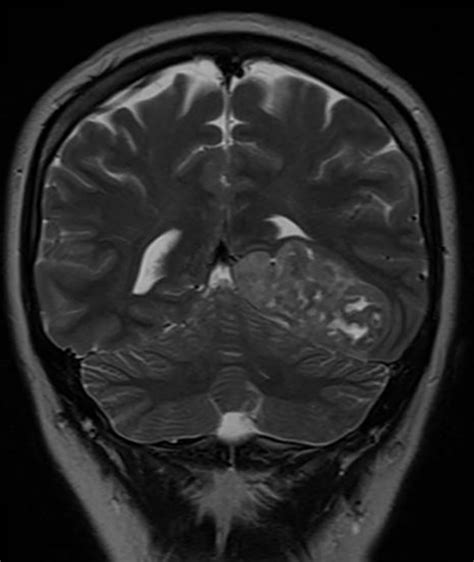 Primary Intracranial Extraskeletal Chondrosarcoma Applied Radiology