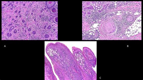 A Adenosquamous Squamous Cell Carcinoma Hematoxylin And Eosin