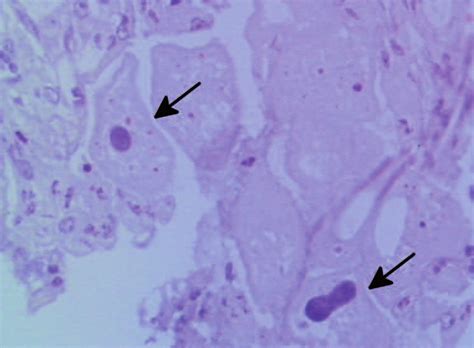 The Large Intestine Of Pigs Infected With Balantidium Coli Revealed