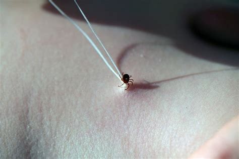 Quick and Easy Tick Removal | Tick removal, Ticks, Survival