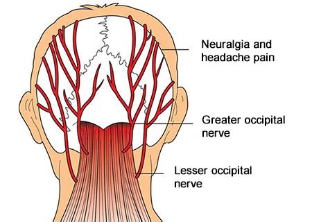 Occipital Neuralgia Pain Locations