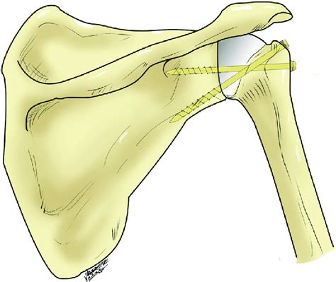 Position Of The Compression Screws Figure 7 The Plate Under The