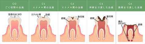 虫歯の治療って痛いの？痛くない治療法はある？｜茨木クローバー歯科 よくあるご質問