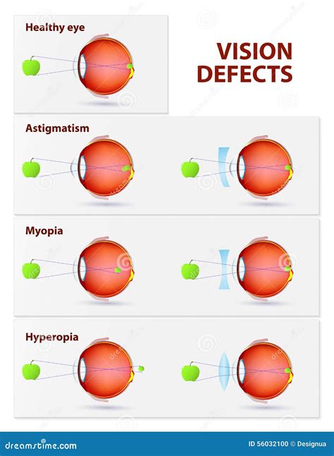 Astigmatism, Myopia And Hyperopia Stock Photo - Image: 56032100