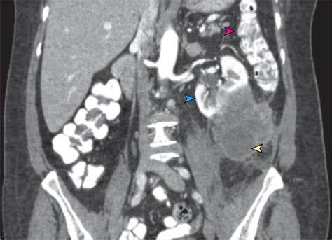 Retroperitoneal Mass Gastroenterology Jama Surgery The Jama Network