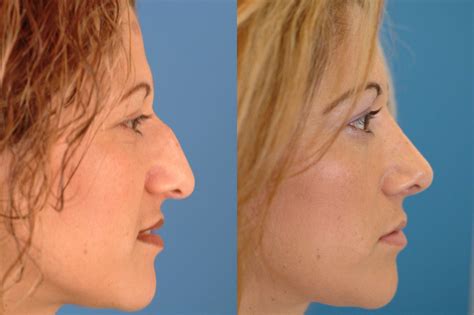 20130523231335303jn Rhinoplasty Dallas Advanced Facial Plastic