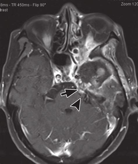 Postoperative Mri Of Cns Aspergillosis On The Rd Day On The