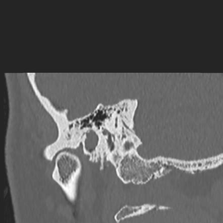 External Auditory Canal Cholesteatoma Image Radiopaedia Org