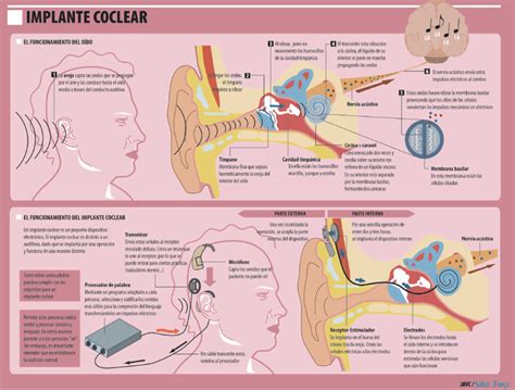 Implantes Cocleares Aprender A O R De Nuevo Salud Ediciones