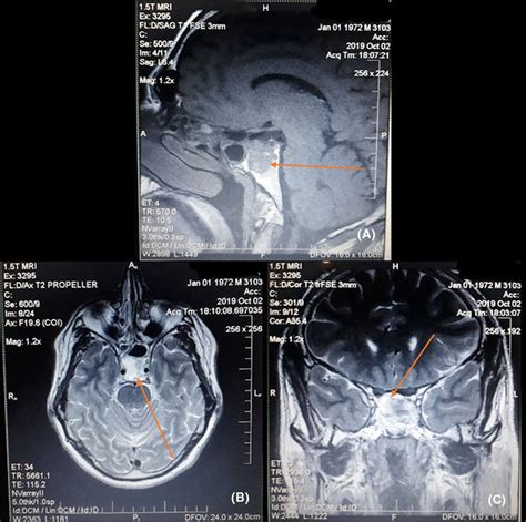 A B And C Mri With Contrast Of Sphenoid Sinus And Pituitary Gland