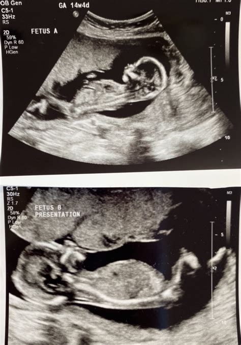 16 Weeks Pregnant With Twins The Way It Really Is