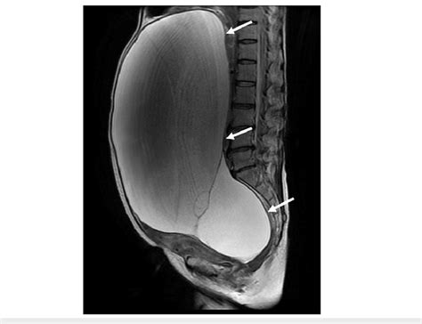 Ovarian Cyst Mri T2 Weighted Imaging Demonstrates A Huge