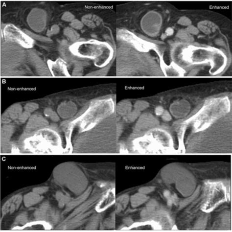 Hernia characteristics measured on CT scan, such as longitudinal hernia... | Download Scientific ...