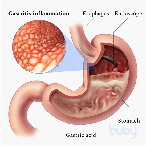 Gastritis: What It Is, Symptoms, Causes Treatment, 50% OFF