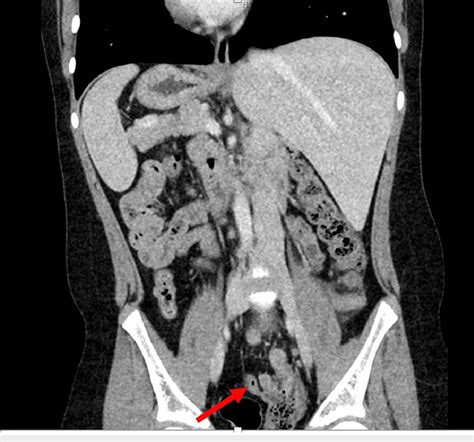 CT scan (coronal view). The red arrow points to the thickening of the... | Download Scientific ...