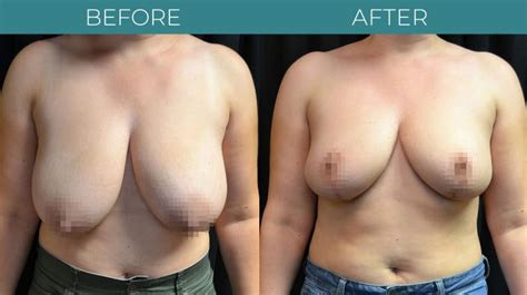 Breast Reduction Virginia Berman Cosmetic Surgery