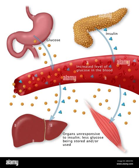 Diabetes tipo II Fotografía de stock - Alamy