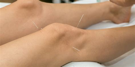 Acupuncture For Meniscus Tears A Natural Way To Support Your