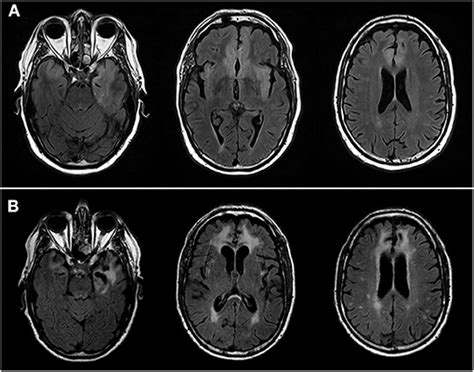 Frontiers Two Cases Of Late Onset Anti NMDAr Auto Immune Encephalitis