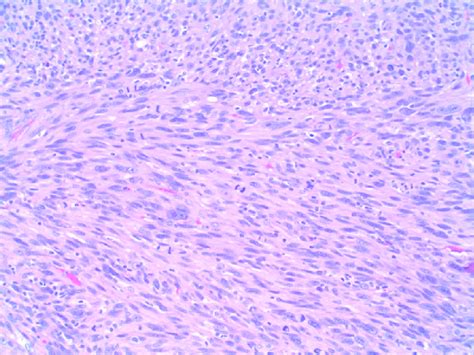 Histopathology Hematoxylin And Eosin Stain Of Re Biopsy Showed