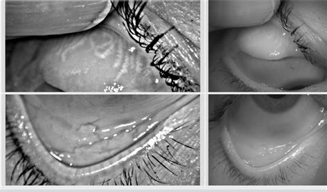 The Meibomian Glands And Dry Eye Sclerallens