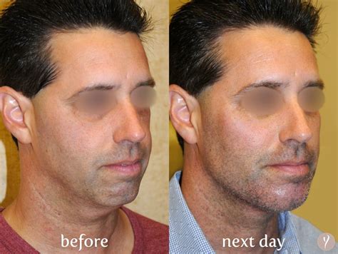 Facial Rejuvenation The Dr Nangrani LIFT Vedas Medical Spa