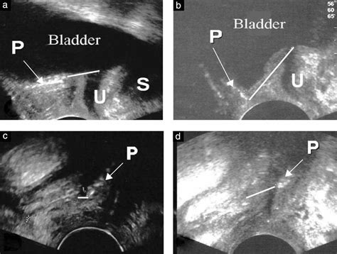 Transvaginal Mesh Repair Of Anterior And Posterior Vaginal Wall