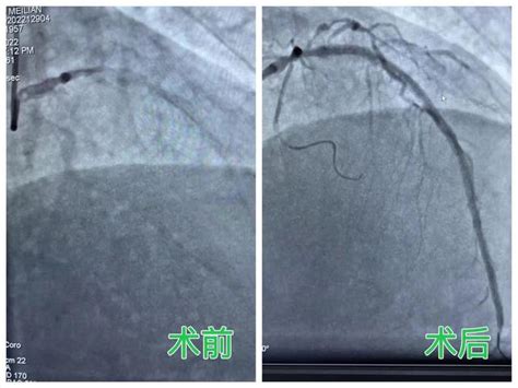 15毫米的「金剛鑽」救了六旬老人一命，寧鄉市人民醫院成功開展ivus冠狀動脈旋磨技術 每日頭條