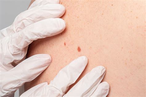 Melanoma E Tumori Della Pelle La Prevenzione Vincente Humanitas